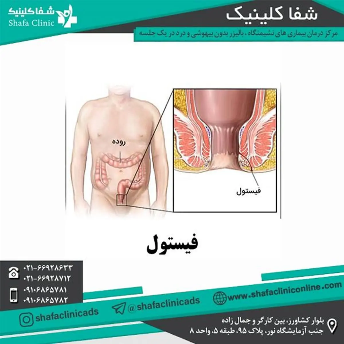 درمان هموروئید در شفا کلینیک