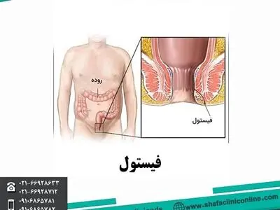 درمان هموروئید در شفا کلینیک