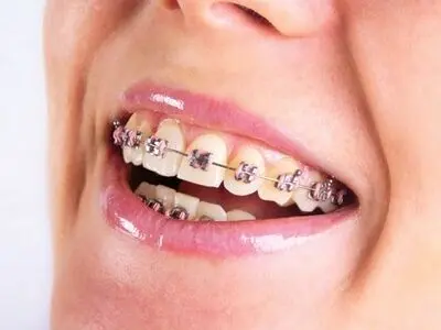 همه چیز درباره ارتودنسی