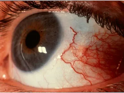 خطر تشخیص اشتباه این عفونت و از دست رفتن دائم بینایی