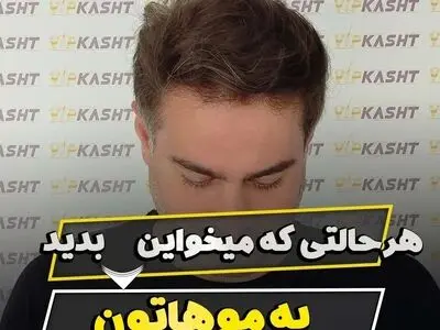 کاشت مو در تهران با خط رویش طبیعی و پرتراکم