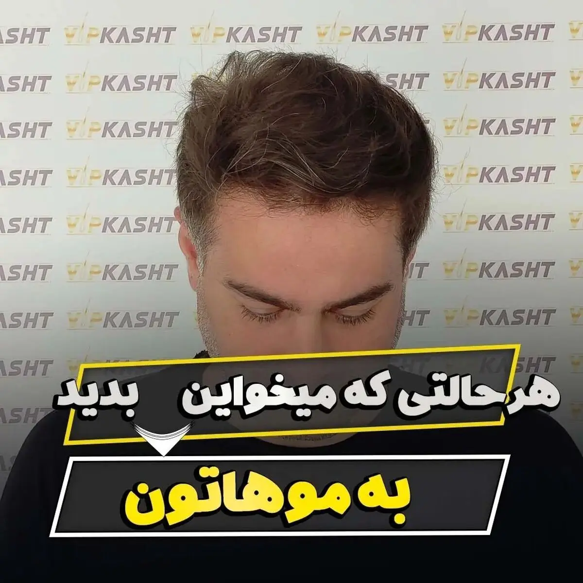 کاشت مو در تهران با خط رویش طبیعی و پرتراکم