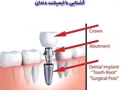 آشنایی با ایمپلنت دندان