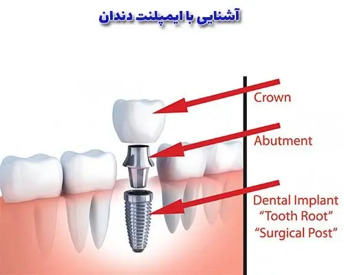 آشنایی با ایمپلنت دندان