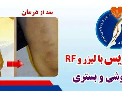 متخصص درمان واریس