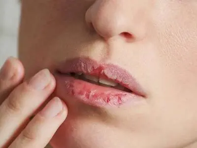 درمان و پیشگیری از ترک خوردگی لب