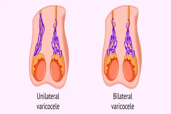 واریکوسل چیست و چگونه درمان می شود؟