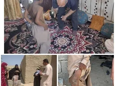 بررسی تخصصی ادعای شیوع بیماری «گال» در سراوان