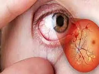 راه‌های جلوگیری از آسیب چشم ناشی از قند خون