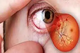 راه‌های جلوگیری از آسیب چشم ناشی از قند خون