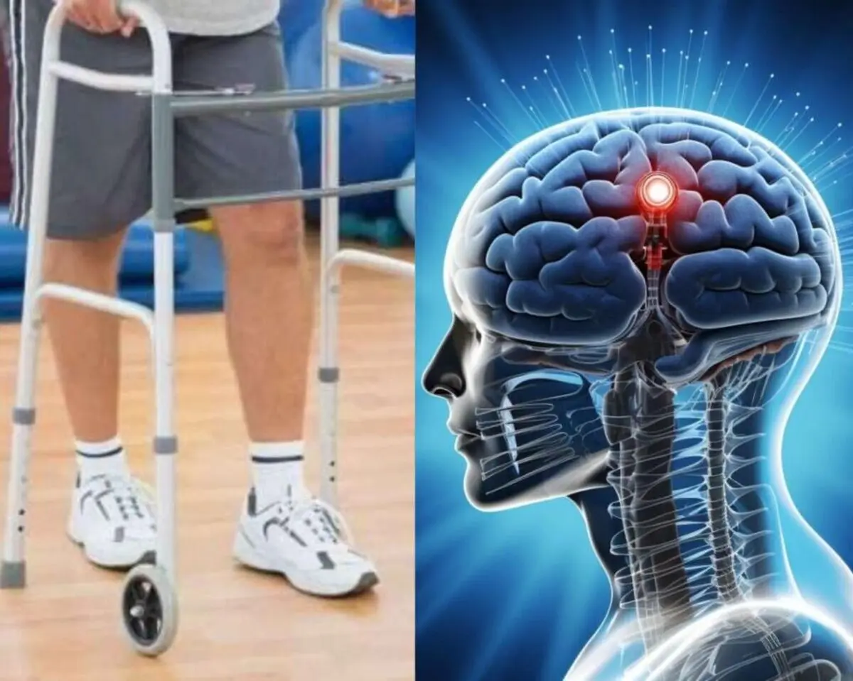 دو فرد مبتلا به ‎آسیب نخاعی پس از کاشت الکترود در مغزشان، قادر به راه رفتن شدند