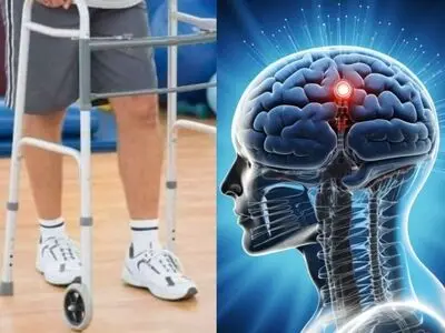 دو فرد مبتلا به ‎آسیب نخاعی پس از کاشت الکترود در مغزشان، قادر به راه رفتن شدند