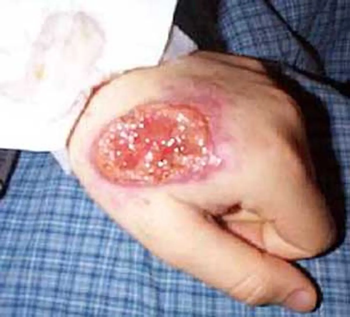  نماینده دامغان: سالک ریشه کن می شود/ سرپرست شبکه بهداشت: ریشه کنی سالک غیرممکن است