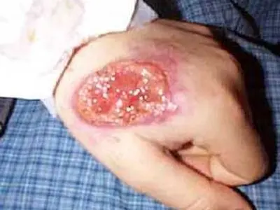  نماینده دامغان: سالک ریشه کن می شود/ سرپرست شبکه بهداشت: ریشه کنی سالک غیرممکن است