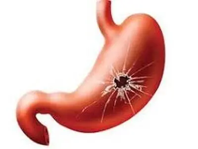 همه چیز درباره زخم معده