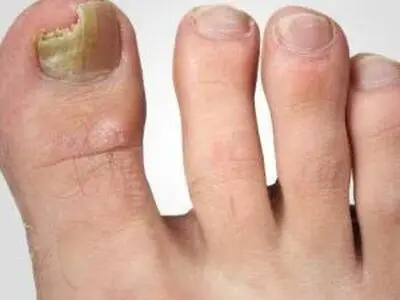 علل و علایم افتادن ناخن پا