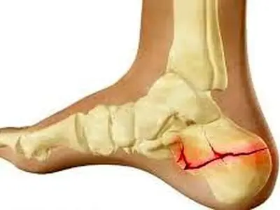 ابداع قوی ترین چسب استخوان در چین+فیلم