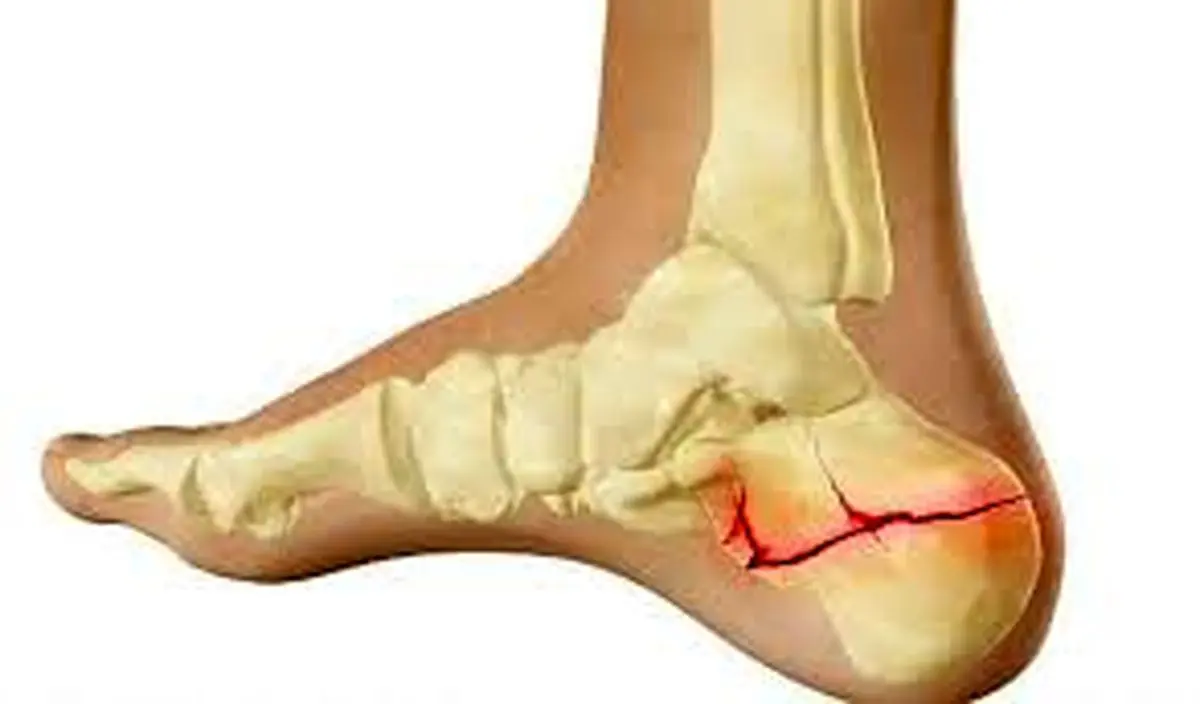 ابداع قوی ترین چسب استخوان در چین+فیلم