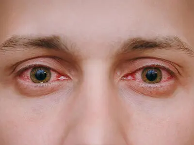 نور جوشکاری چه آسیبی به چشم‌ها وارد می‌کند؟