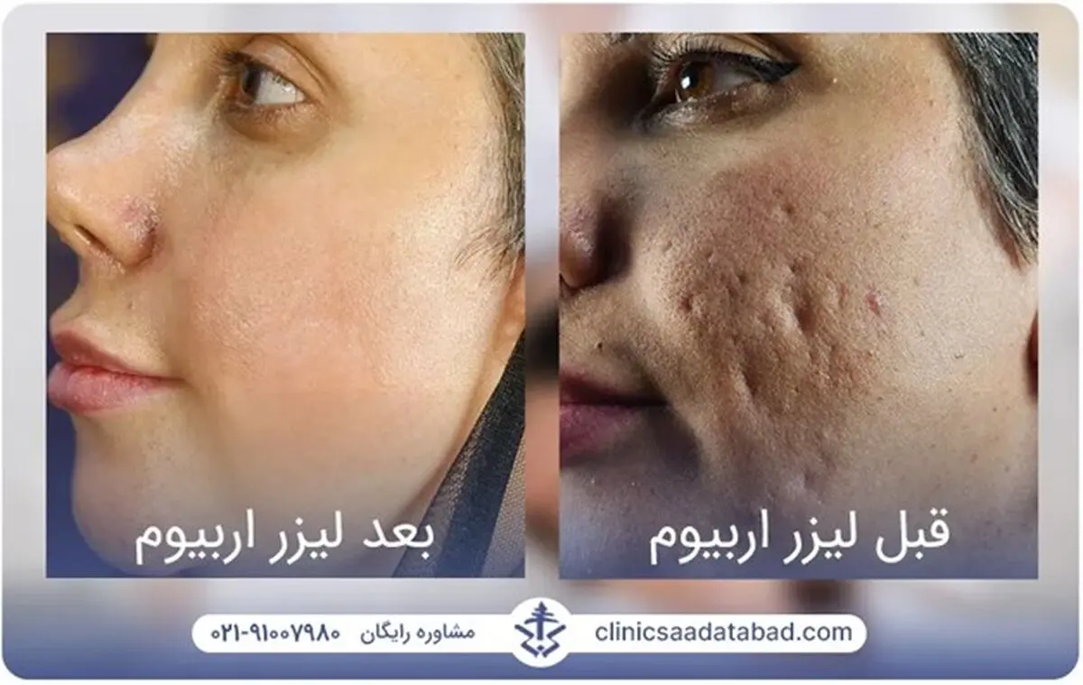 لیزر اربیوم؛ درمان فوری و قطعی جای جوش، حذف تتو و بخیه