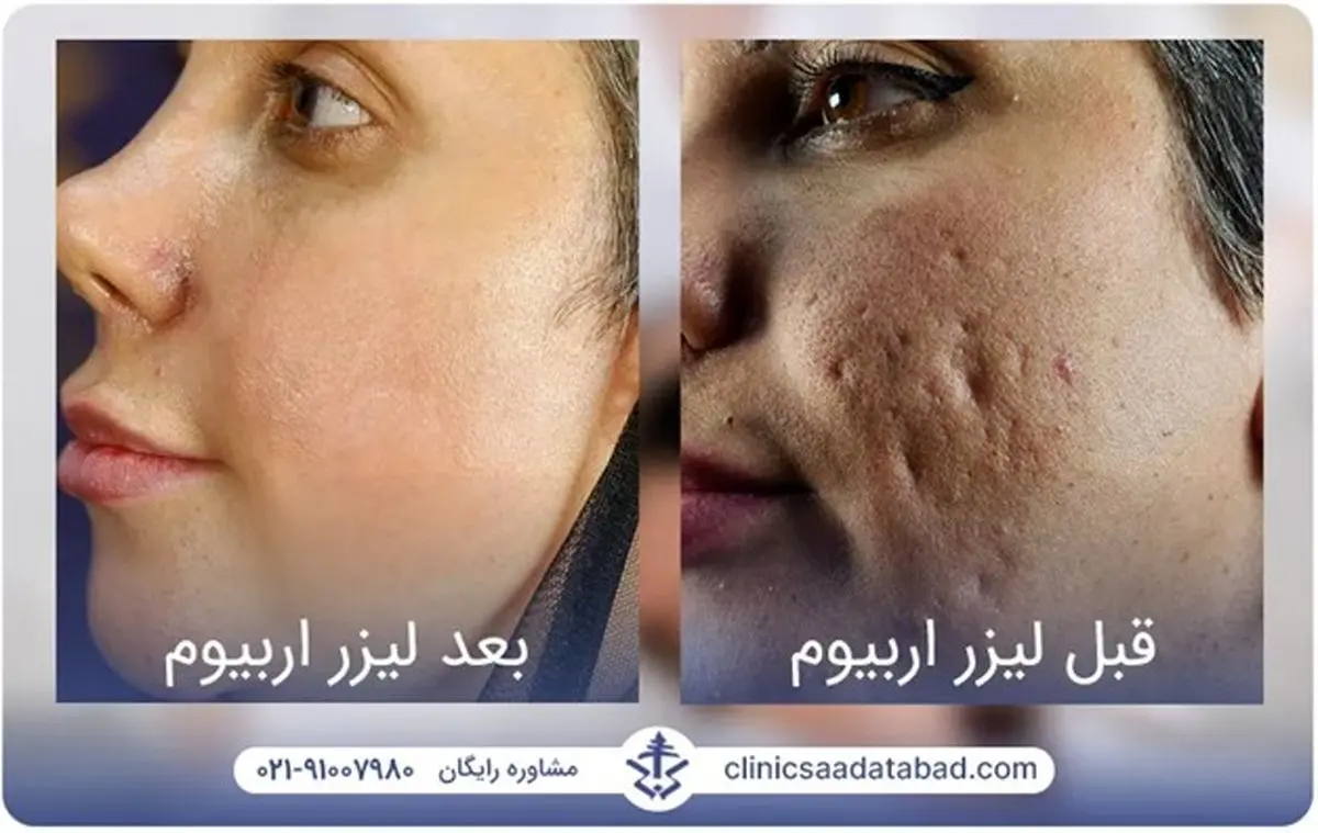 لیزر اربیوم؛ درمان فوری و قطعی جای جوش، حذف تتو و بخیه