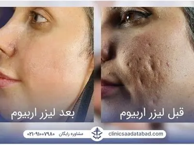 لیزر اربیوم؛ درمان فوری و قطعی جای جوش، حذف تتو و بخیه