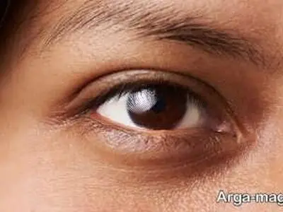 روش از بین بردن حلقه های تیره زیر چشم 