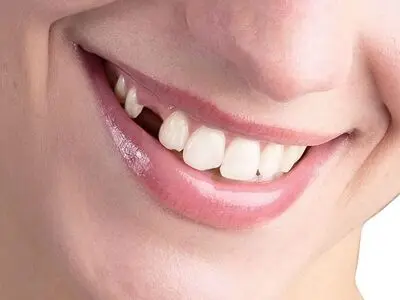 با رایج ترین روش های جایگزینی دندان از دست رفته آشنا شوید!