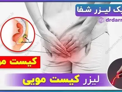 آشنایی با لیزر کیست مویی 
