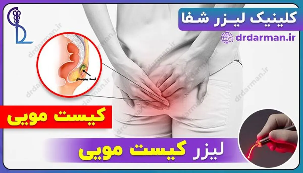 آشنایی با لیزر کیست مویی 