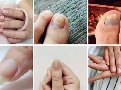 این علامت ها روی ناخن یعنی کلسترول خون شما بالا است