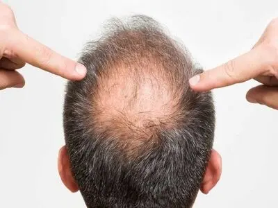 کشف جدیدی برای جلوگیری از ریزش مو