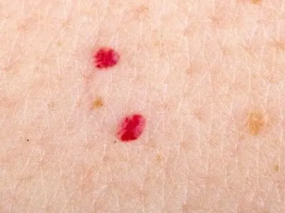 لکه‌های قرمز کوچک روی پوست و دلایل بروز آنها