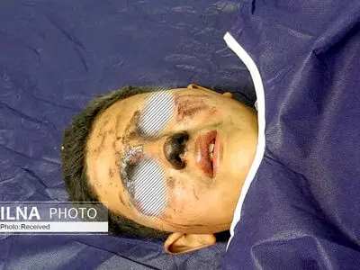 افزایش مصدومان قطع عضو در حوادث آخرین چهارشنبه سال