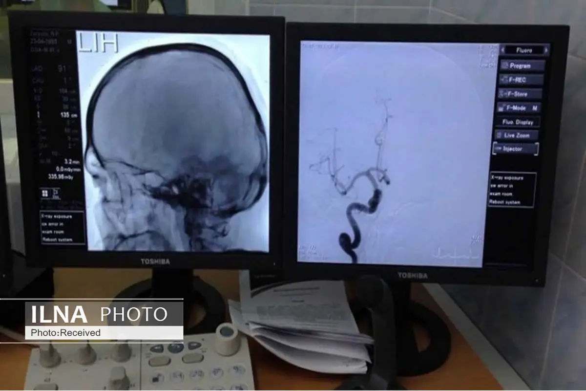 آنژیوگرافی مغزی برای اولین بار در بیمارستان بوعلی قزوین انجام شد