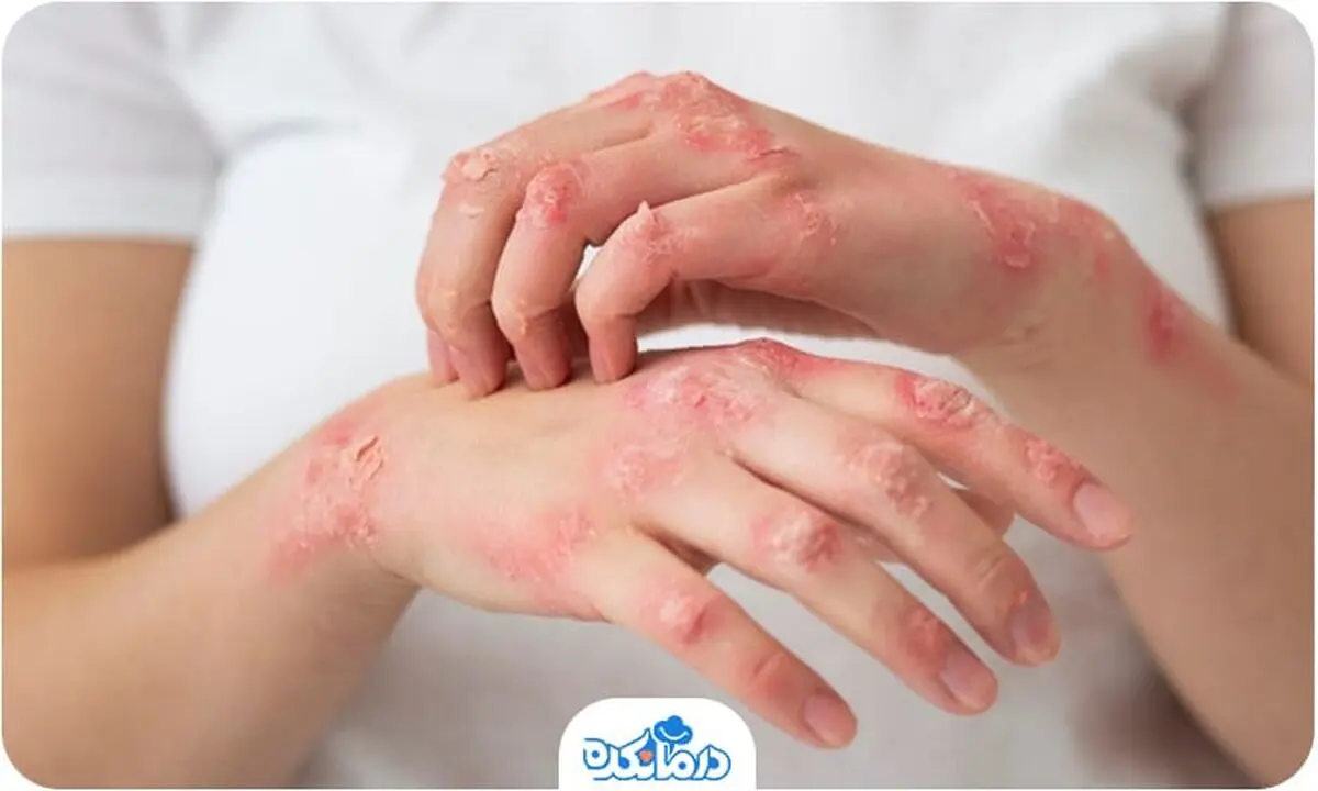 علائم جذام را بشناسید + اینفوگرافیک