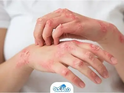 علائم جذام را بشناسید + اینفوگرافیک