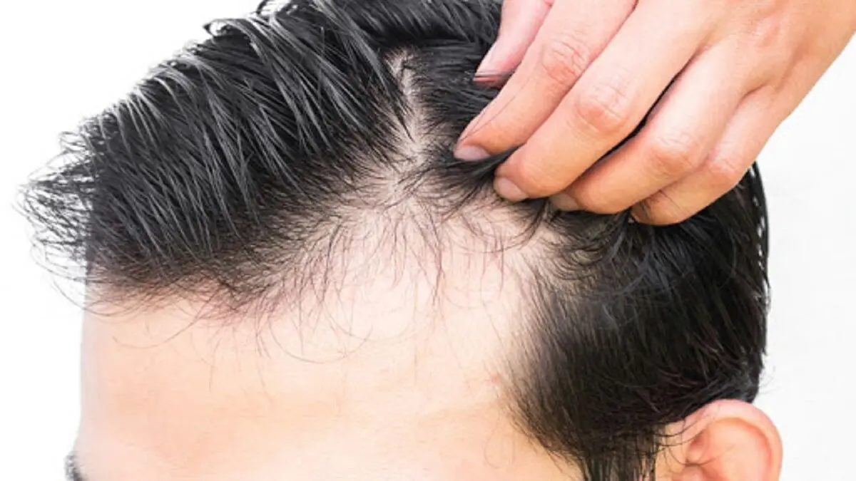 ۴ دلیل شایع ریزش مو در جوانی 