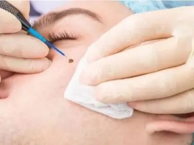 علت برگشت خال بعد از سوزاندن + عکس