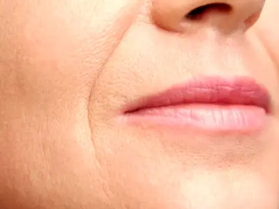 راهکارهای مناسب برای درمان چروک دور لب