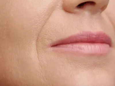 راهکارهای مناسب برای درمان چروک دور لب