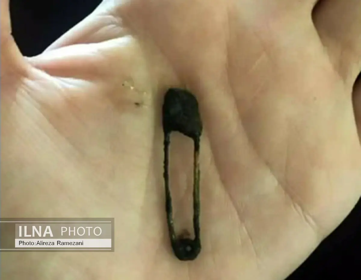 ۶ماه تنفس با سنجاق قفلی داخل بینی +تصویر 