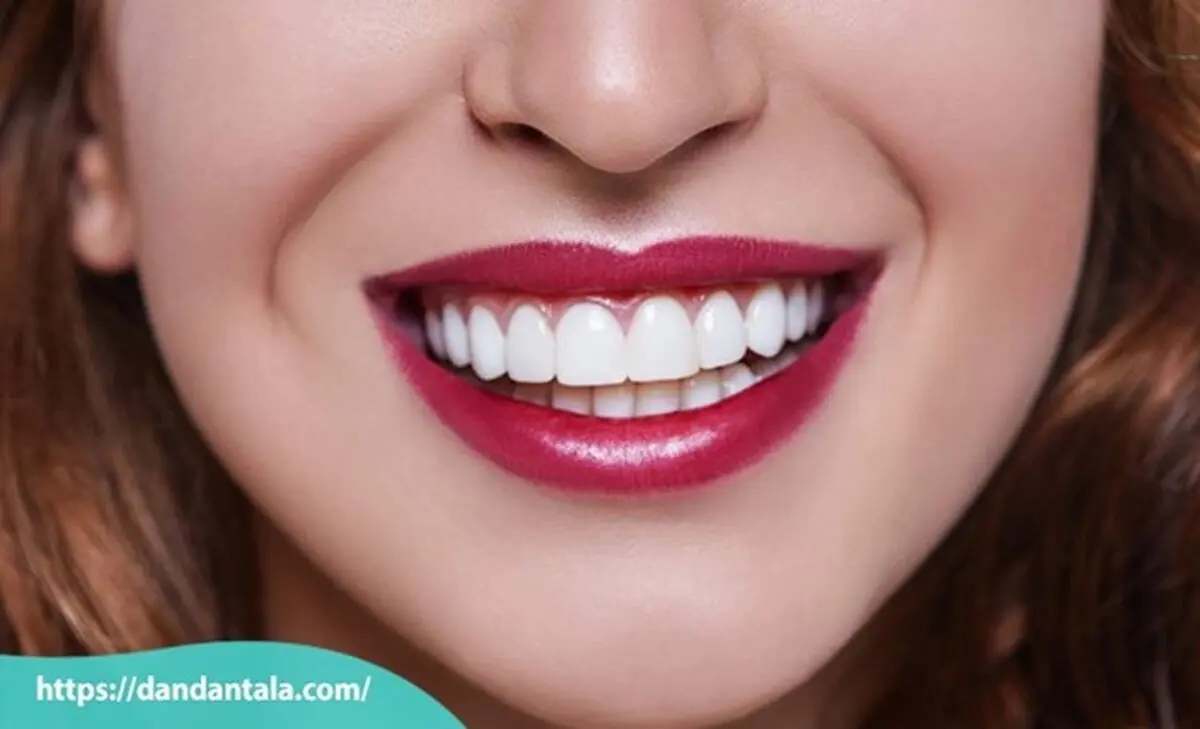 اصلاح طرح لبخند با لمینت یا کامپوزیت کدام یک بهتر است؟