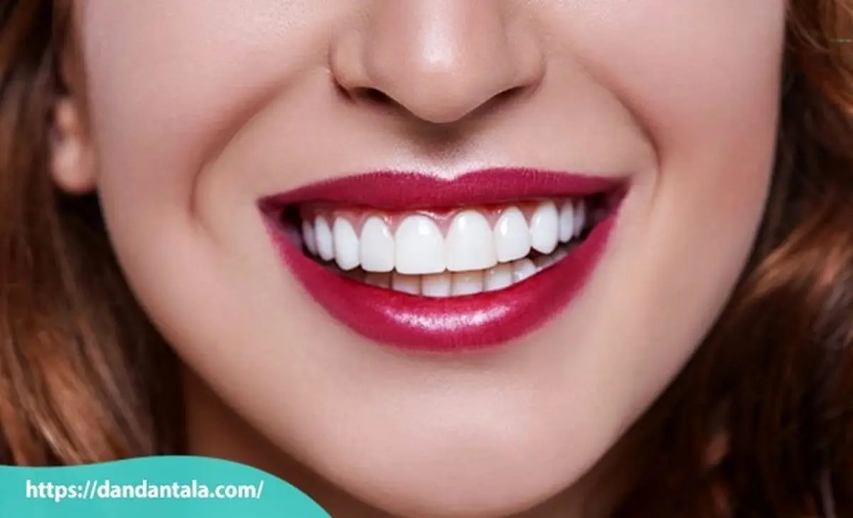 اصلاح طرح لبخند با لمینت یا کامپوزیت کدام یک بهتر است؟