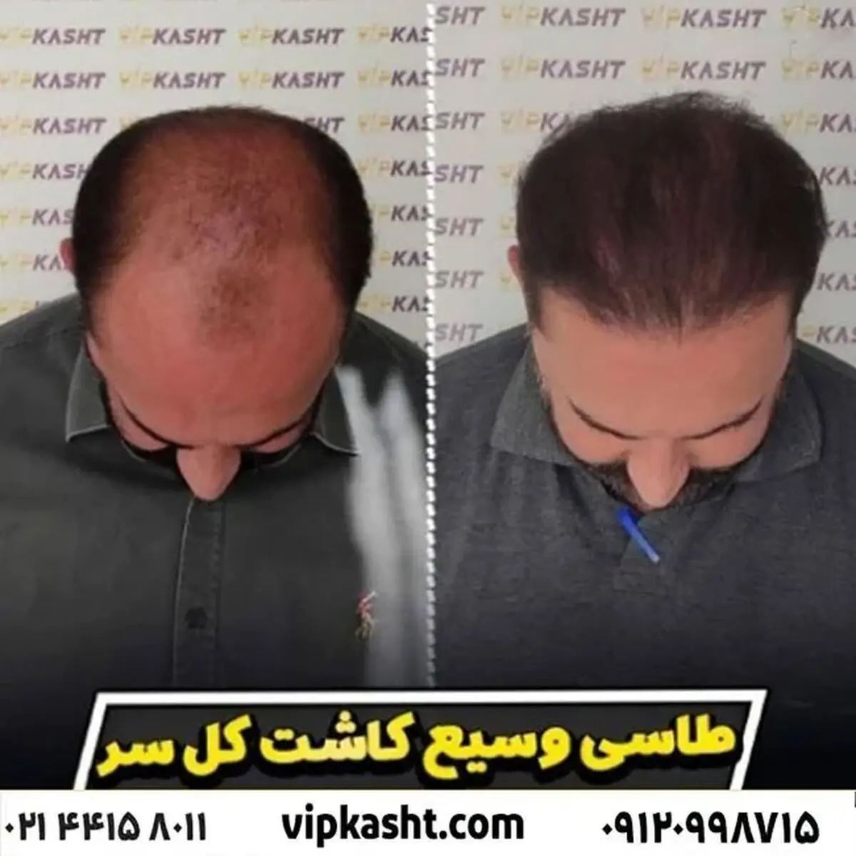 نظر کسانی که کاشت مو انجام داده اند