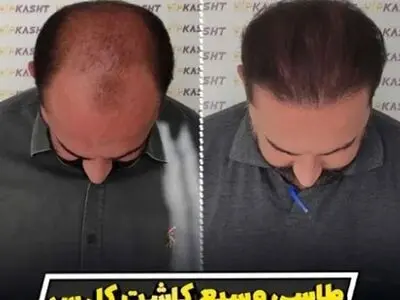 نظر کسانی که کاشت مو انجام داده اند