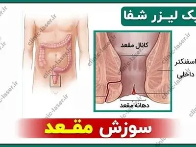 سوزش مقعد و راه‌های درمان آن از نظر دکتر داود تاج بخش