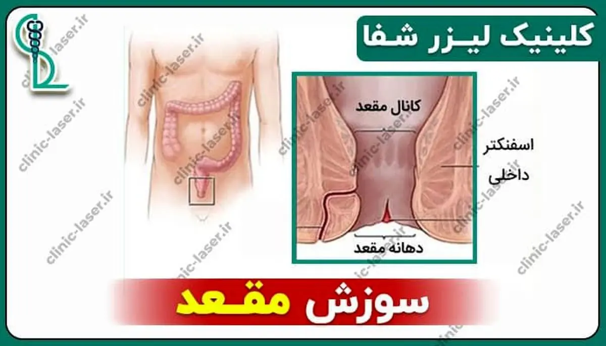 سوزش مقعد و راه‌های درمان آن از نظر دکتر داود تاج بخش