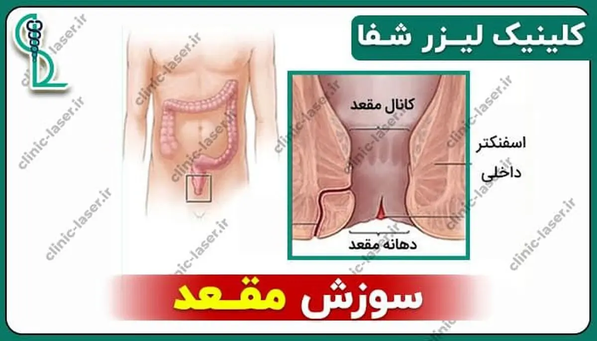سوزش مقعد و راه‌های درمان آن از نظر دکتر داود تاج بخش