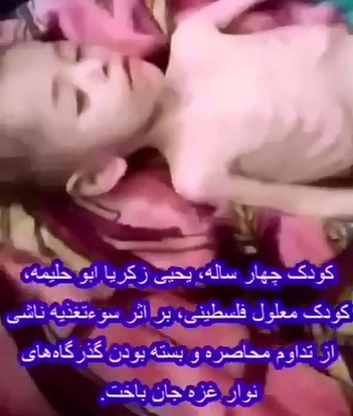 کودک معلول فلسطینی، بر اثر سوءتغذیه ناشی از تداوم محاصره جان باخت + فیلم